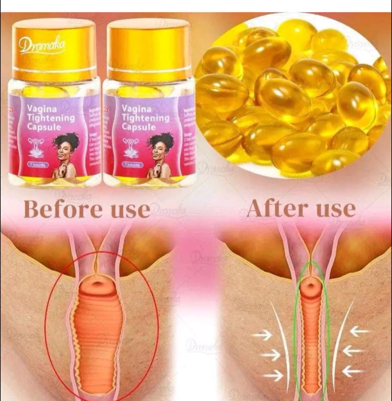Gélules pour simuler la verginité et pour resserrer le vagin